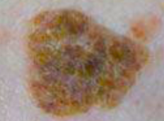 老人斑、太陽斑 (Age spots and sun spots)