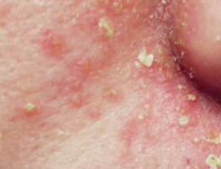 脂漏性皮膚炎 (Seborrhoeic Dermatitis)