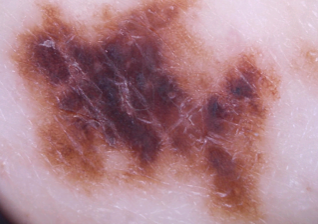 皮膚癌 (Skin Cancers)