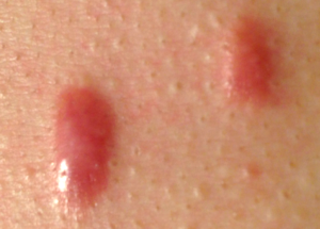 疤痕淡化治療 ( Scar treatment)