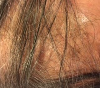 脫髮 (Alopecia)