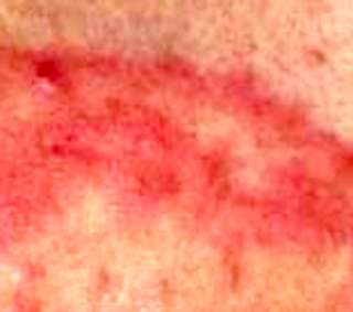 皮癬 (Tinea)