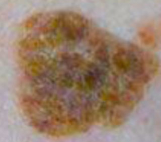 老人斑、太陽斑 (Age spots and sun spots)
