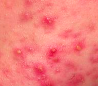 青春痘 (Acne)