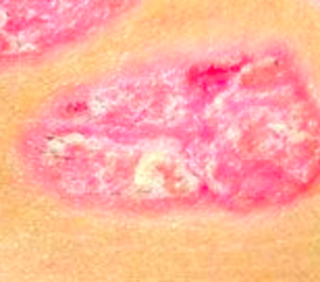 牛皮癬 (Psoriasis)