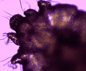 疥瘡 (Scabies)